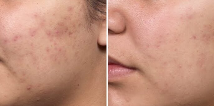 before and after acne treatment