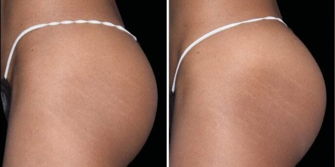 before after emsculpt-2
