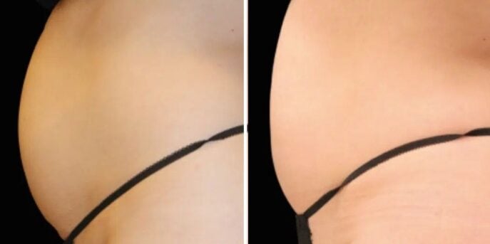 before after emsculpt-3