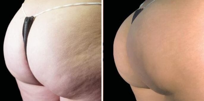 before after emsculpt