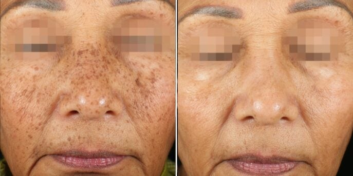 before after picosure-2
