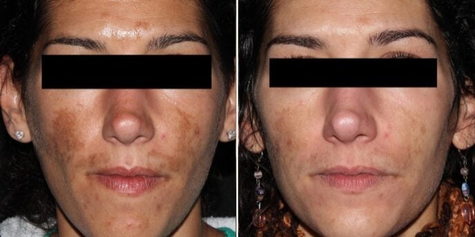 before after picosure-3