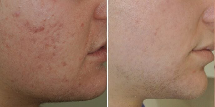 before after scar removal