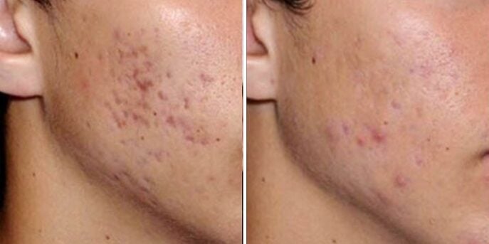 before after scar removal