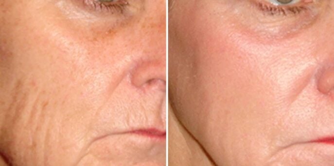 before after thermafrac