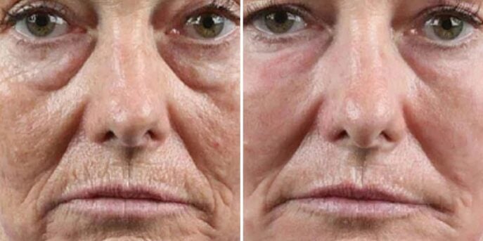 before after thermafrac-exosomes