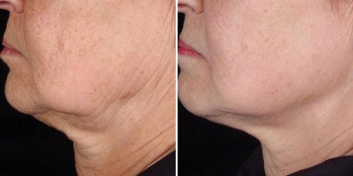 before after titan-skin-tightening