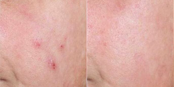 before and after acne treatment