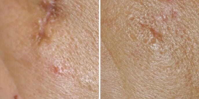 before and after acne scar treatment