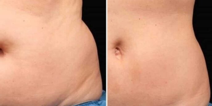 before and after coolsculpting stomach