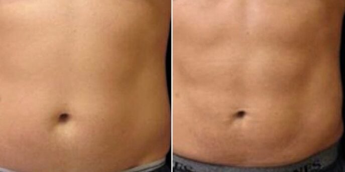 before and after emsculpt-2