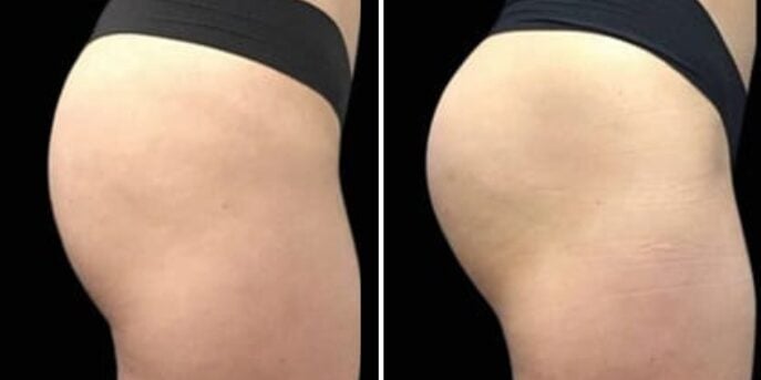 before and after emsculpt-3