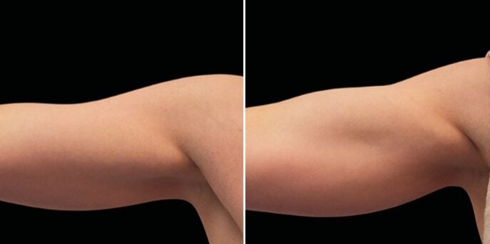 before and after emsculpt
