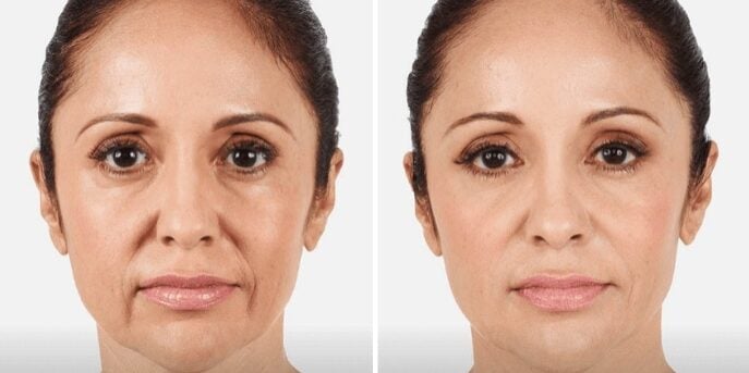 before and after fillers