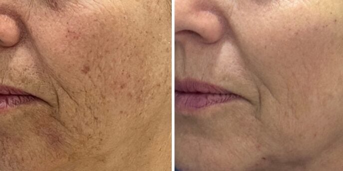 before and after laser-2