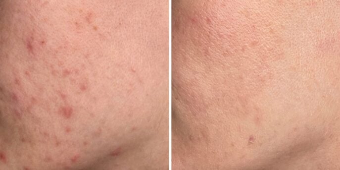 before and after laser treatment