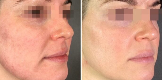 before and after laser treatment