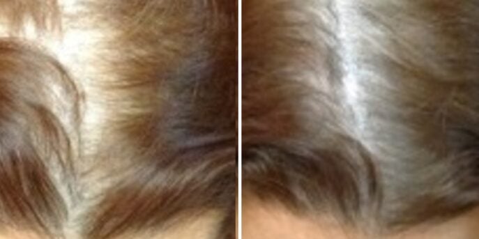 before and after laser hair restoration-2