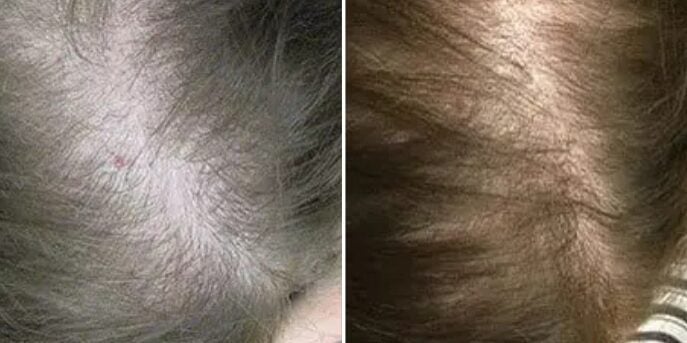 before and after laser hair restoration