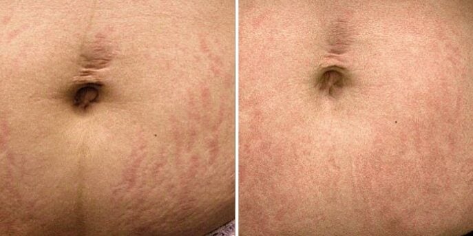 before and after laser stretchmark removal-2