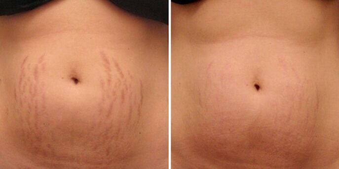 before and after laser stretchmark removal