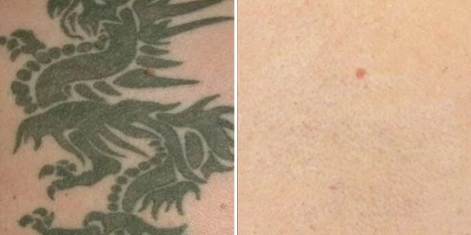before and after laser-tattoo-removal 1