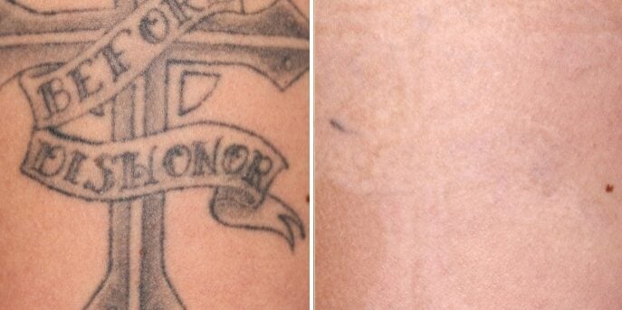 before and after laser-tattoo-removal-3