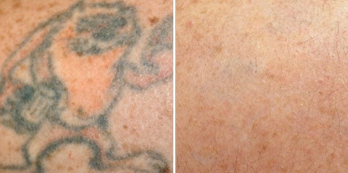 before and after laser-tattoo-removal