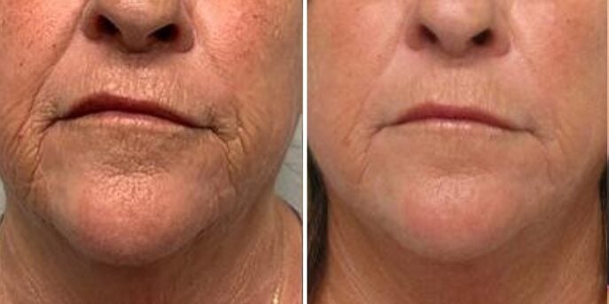 before and after microneedling-2
