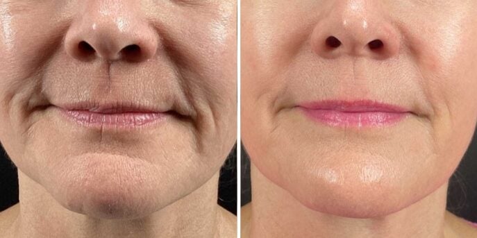 before and after microneedling