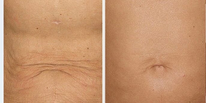 before and after thermage-skin-tightening