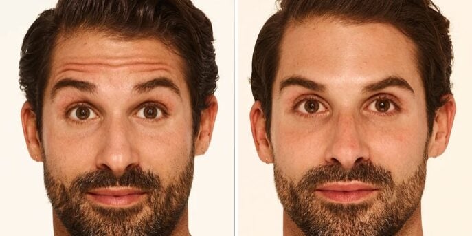 botox-before-after