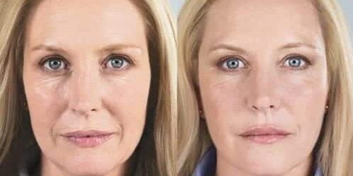 sculptra before and after