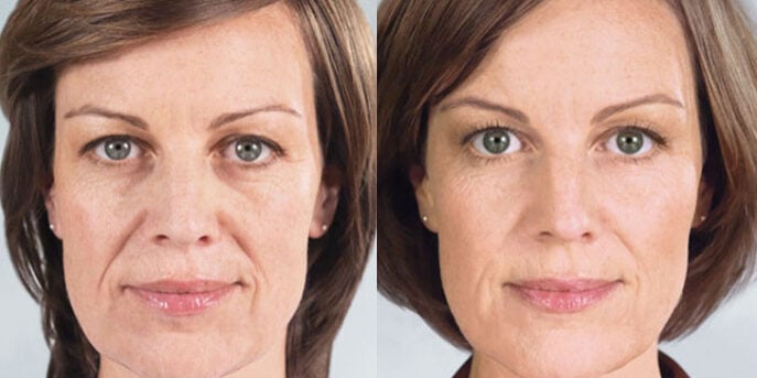 sculptra before and after